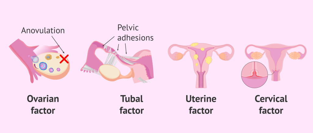 Causes of Female Infertility