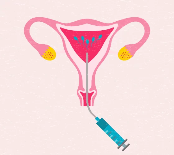 Intra Uterine Insemination