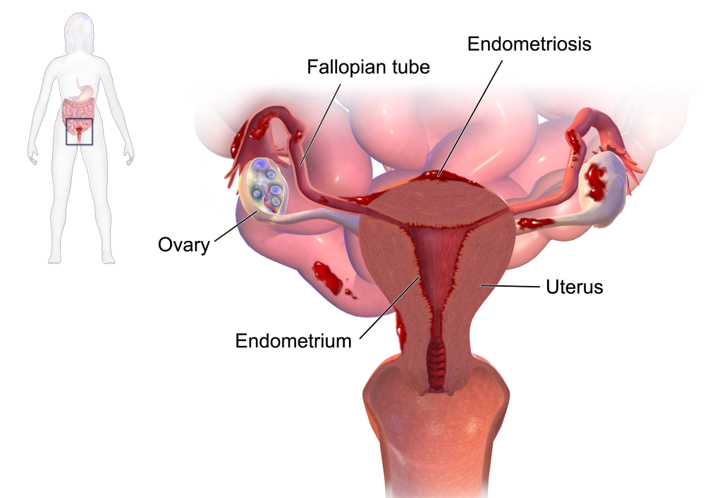 Endometriosis