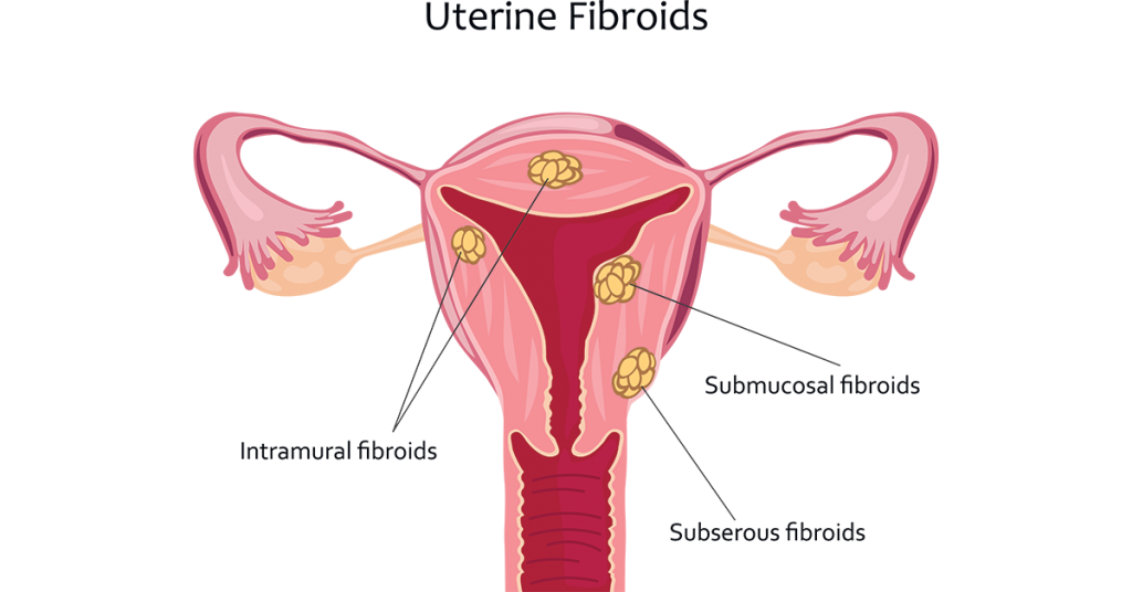 Uterine Fibroids