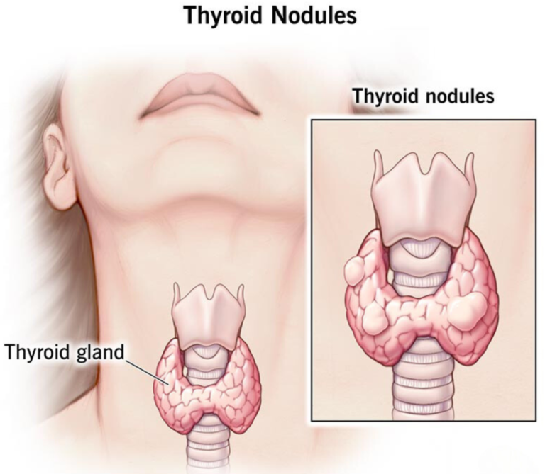 Thyroid