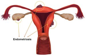 Endometriosis