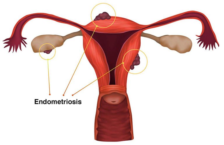 Endometriosis