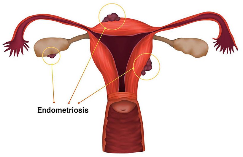 Endometriosis